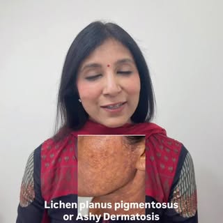 Pigmentation on face #facepigmentation #pigmentation
