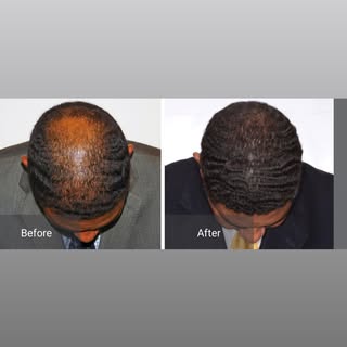 Now pleased to offer BOTH strip and FUE methods of hair transplantation. 
#futhairtransplant #fuehai