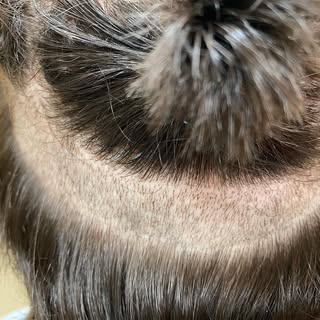 The scarring that you see on this patient’s scalp is all from his FUE procedure in 2019. It is a mis