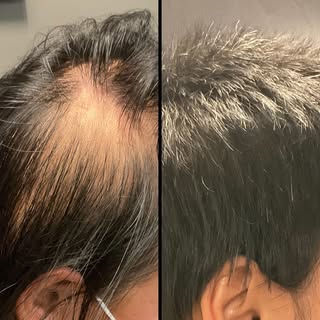 Another incredible result post PRP therapy for hair loss in our patient. Swipe right for her reactio