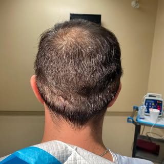 One of the most common questions we get asked: “how bad is the scar after a hair transplant?”
The an