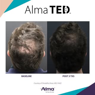 Befores and Afters #ted #alma #almated