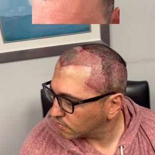 Hair Transplant Patient Review: 3,500 graft FUE procedure with Dr. Blake Bloxham 
#hair #hairloss #h