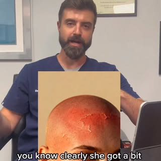 Sunburn after a hair transplant? 🚫 Not today. Here’s how UV messes with grafts—and exactly when it’