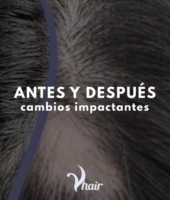Antes y después | Alopecia Areata, Alopecia Androgenética, Alopecia por tracción, y más!
Podés empez