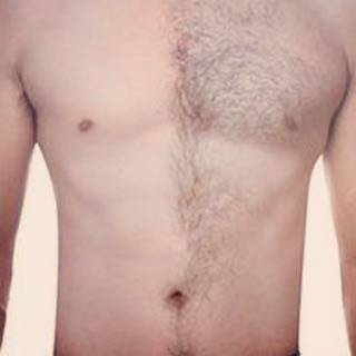 Epilation hommes laser medical Alexandrite Cynosure 🤗#epilationlasermarrakech