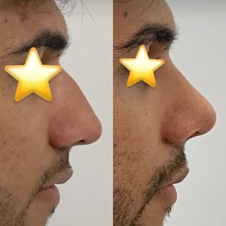 Une rhinoplastie non chirurgical 💫 injcetion d’acide hyaluronique 💉
