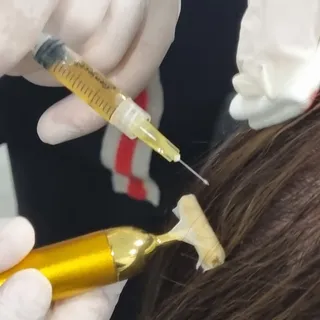 PRP therapy (Platelet rich plasma) is the injecting of a powerful serum, derived from the person’s o