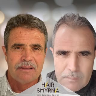 Hair Transplant 12 Months Results

This photo is post with the consent of the patient and for inform