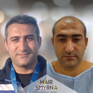 Hair Transplant 12 Months Results

This photo is post with the consent of the patient and for inform