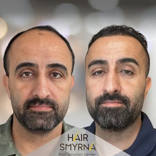 Hair Transplant 12 Months Results

This photo is post with the consent of the patient and for inform