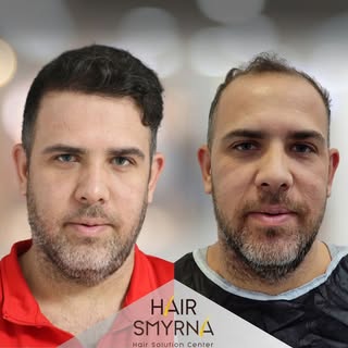 Hair Transplant 12 Months Results

This photo is post with the consent of the patient and for inform