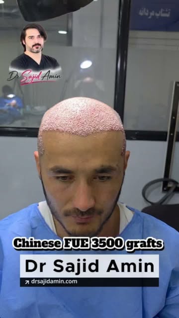 Half head | 3500 Grafts | Dr Sajid Amin