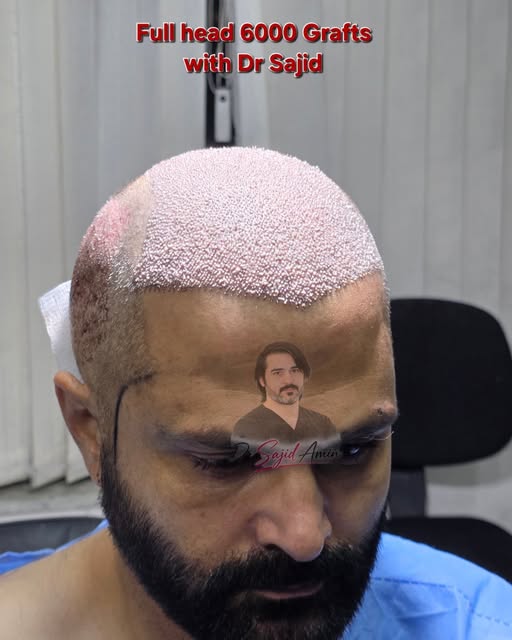 Full head 6000 Grafts Chinese FUE with Dr Sajid