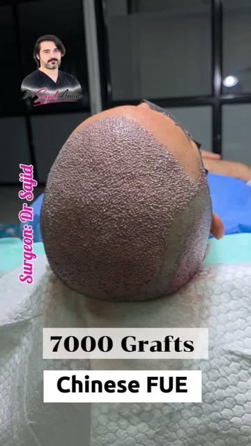 Full head | 7000 Grafts | Chinese FUE | D4 Sajid | Kabul Peshawar Islamabad | 0774300922-03318822666