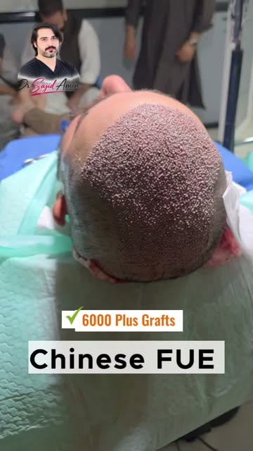 6000 plus grafts | Chinese FUE | Dr Sajid Amin | Kabul-Islamabad | 03318822666-0784300922
