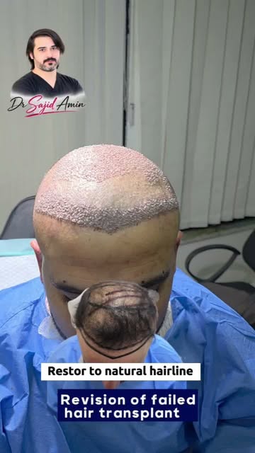 Revision of failed and un natural hair transplantation