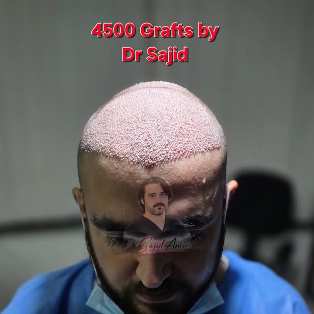4500 Grafts | Half Head | Dr Sajid Amin | Chinese FUE | Kabul - Islamabad | 0774300922 - 03318822666