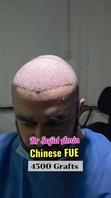 4500 Grafts | Chinese FUE | Dr Sajid Amin | Kabul-Islamabad | 0774300922-03318822666