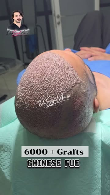 6000 + Grafts | Chinese FUE | Dr Sajid Amin | kabul-Islamabad | 0774300922-03318822666