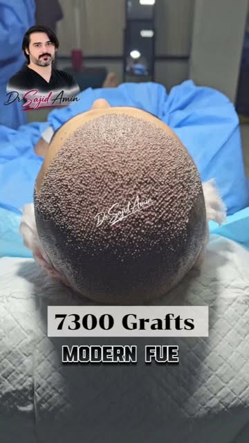 Modern FUE | Dr Sajid Amin | Kabul Islamabad | 0774300922 03318822666