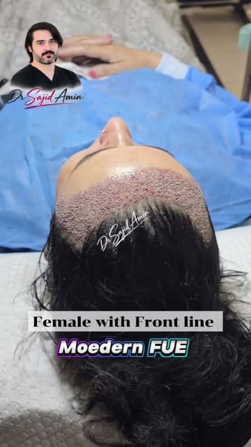 Female Frontal session | Dr Sajid Amin | Modern FUE | Kabul Islamabad | 0774300922 03318822666