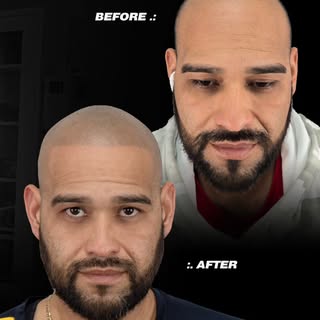 ✨ De la Pérdida de Cabello → A la Confianza 

¿Cansado de gorras, productos que no funcionan o de es