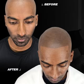 ✨ From Hair Loss → To Confidence ✨

Tired of hats, hair products, or hiding your hairline? At InkVis