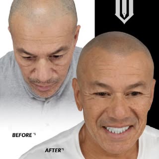 Age doesn’t define confidence — results do.
Today’s transformation is proof that SMP is for every ma