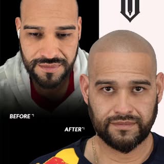 ¿Listo para verte más joven otra vez?
Con InkVision SMP, puedes recuperar una línea de cabello natur