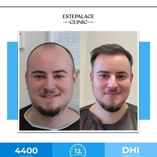 4400 grafts were transplanted to our patient using DHI technique.✨

You can contact us to get the be