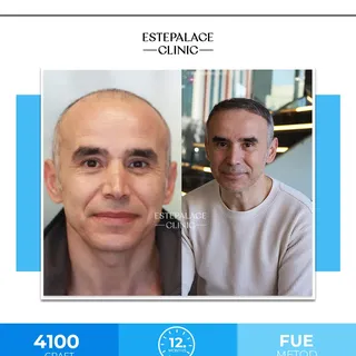 4100 grafts were transplanted to our patient using FUE technique.✨

You can contact us to get the be