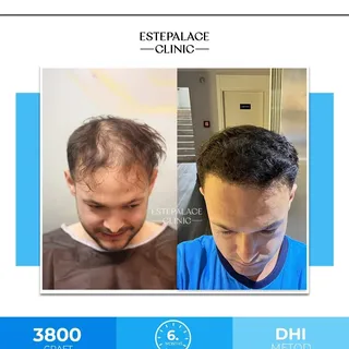 3800 grafts were transplanted to our patient using DHI technique.✨

You can contact us to get the be