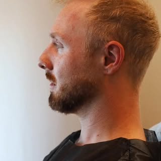 Hair Transplant ✨