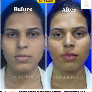 Beautiful lips are all about balance and harmony—not just volume. 💋

Lip fillers with Hyaluronic Ac
