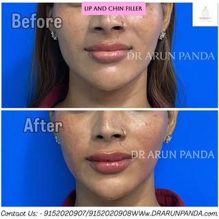 Lip and chin filler,