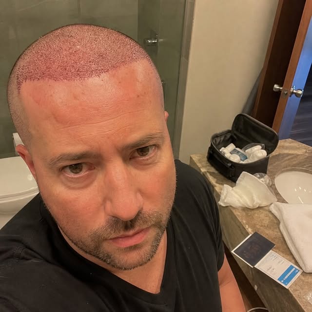 A hair transplant can move hair.

It does not always stop the rest from continuing to thin.

Before 