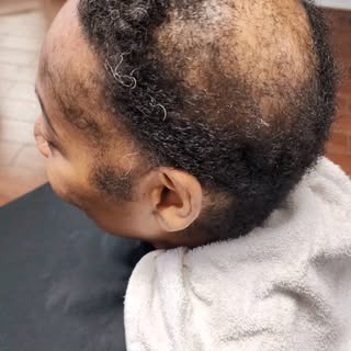 #hairloss comes in many forms.  I provide natural looking options to accommodate your particular sit