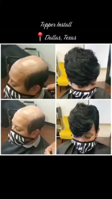 Hair loss doesn't define you. Confidence does.
Whether you're experiencing thinning, alopecia, hormo