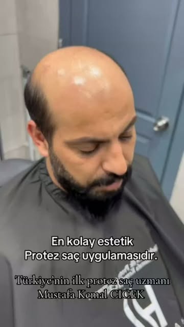 #mustafakemalçiçek #protezsaçmerkezi #protezsaçbakımı #protezsaç #protezsaçmodelleri