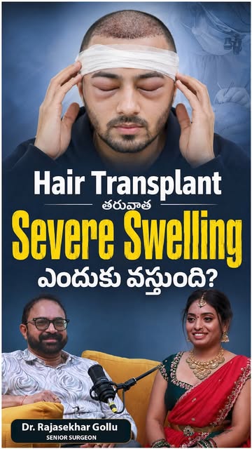 Why Do Eyes Swell After a Hair Transplant? 😱

Does severe swelling happen after a hair transplant? 