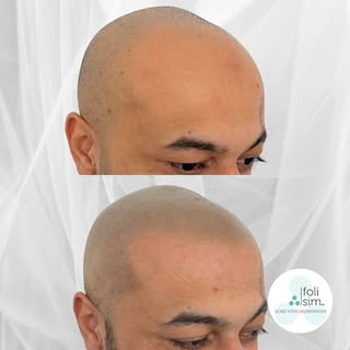 Amazing natural-looking results with Scalp Micropigmentation (SMP) by our artist Nat  working out of