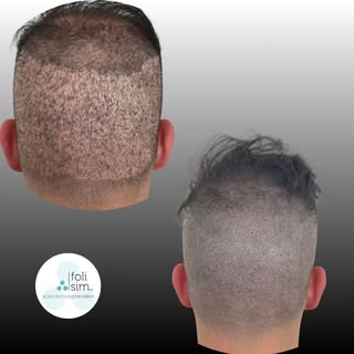 Sometimes when we see people who have previously had a hair transplant they may have visible scarrin