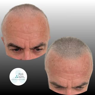 We are often ask if we can do SMP with grey hair? The answer absolutely!

Here is a suitable but not