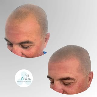 The power of a restored hairline. ✨

​Scalp Micropigmentation (SMP) isn’t just about adding pigment;