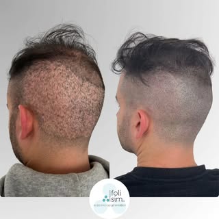 Ever feel like you’re trading one concern for another? 🤔

​FUE hair transplants are incredible for 