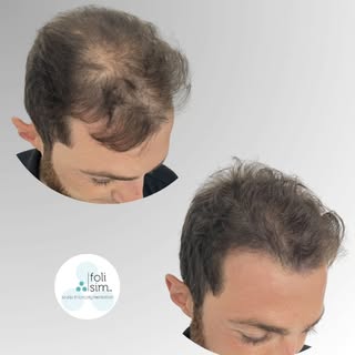 Say Goodbye to the See-Through Scalp 👋✨

​Are you tired of checking the mirror and seeing more scal