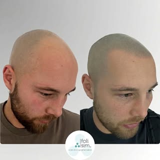 BEFORE ➡️ AFTER: Confidence Restored in Sydney! 💥👀

​This incredible transformation by Nat here at