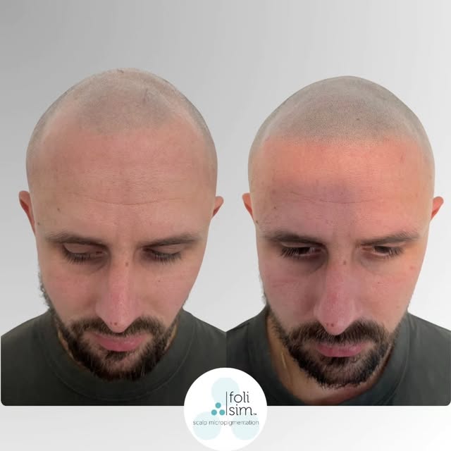 Fresh Results by Nat from our Sydney studio.

​It’s amazing to see the immediate definition a fresh 