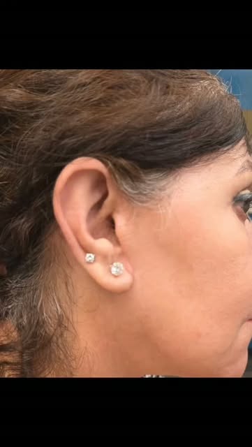 Worried about face lift scars? It is so important to prioritize those details! Scars should be hidde